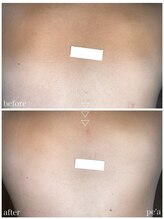 ペア(pe'a)/脱毛before★after[背上]
