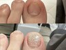 《フット》【深爪矯正】アクリルワンカラー＋角質ケア15分・フットバス付き