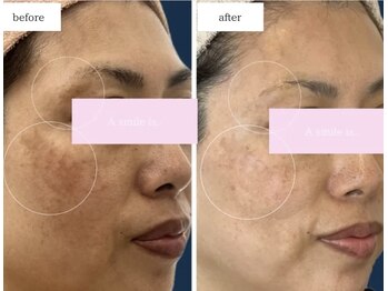 エースマイルイズ(A smile is..)/お客様症例・スキンケア改善