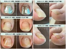 ダイヤモンドボディの雰囲気（皮膚に食い込む巻き爪を整えると皮膚の腫れも改善されていきます）