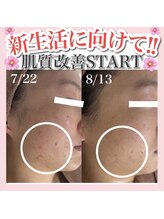 アルムダアクア 天王寺店(Aleumda AQUA)/ハーブピーリング/大阪/天王寺