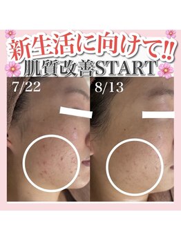 アルムダアクア 天王寺店(Aleumda AQUA)/ハーブピーリング/大阪/天王寺