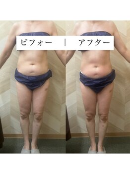 介正鍼灸整骨院 整体院 エフコープ大野城店/痩身エステ＊ビフォーアフター