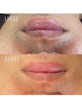 ベルカーラ(Belcarra)/メンズ脱毛/髭脱毛