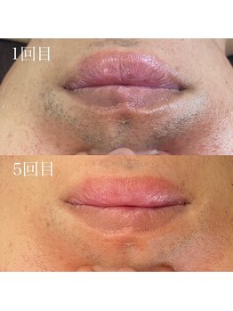 ベルカーラ(Belcarra)/メンズ脱毛/髭脱毛