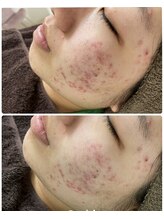 リノベル(LINOBELLE)/ハーブピーリングでニキビケア