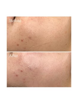 ホワイトワックス 京都四条烏丸(WHITE WAX)/《全顔》フェイシャルワックス