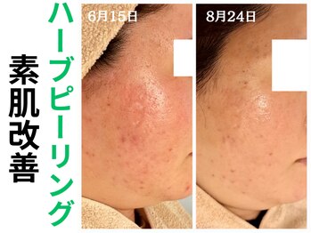 エリン(ERIN)/ハーブピーリング