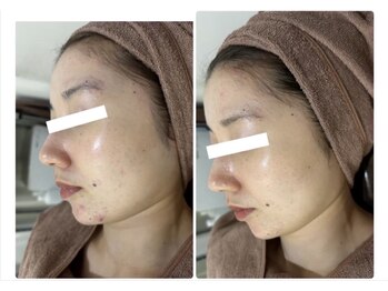 ホワイトアクア 北千住店(WHITE AQUA)/ハーブピーリング/肌質改善/毛穴