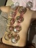 女性&平日限定！背中カッピング　肩こり腰痛血行促進！50分