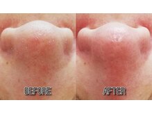 リアン(Riant)/毛穴のお掃除のBEFORE・AFTER