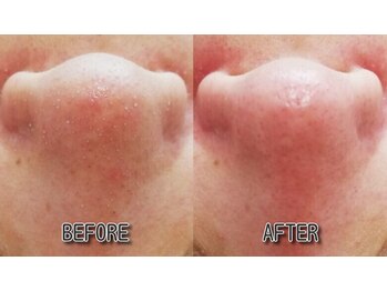 リアン(Riant)/毛穴のお掃除のBEFORE・AFTER