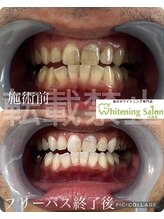 ホワイトニングサロン 広島店/【ホワイトニング施術例】