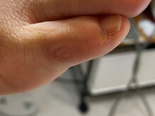 フットメンテ 巻き爪矯正センター 南浦和/小趾の角質