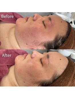 ビトタン 倉敷本店(+美to鍛)/ハーブピーリング1g/1回