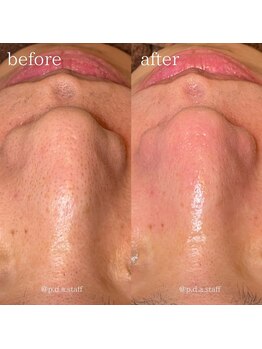 ピーディーエーサロン(PDA salon)/【毛穴洗浄】ビフォアフ