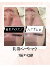 リンフェイス 浦安店(RINFACE)/赤みが出てしまう方にも◎