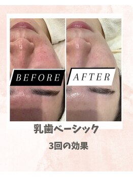 リンフェイス 浦安店(RINFACE)/赤みが出てしまう方にも◎