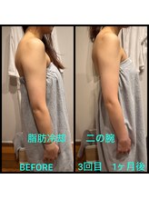 サロン プリーヴィ ドゥブルヴェ(SALON PRIVE W)/脂肪冷却でセル脂肪撃退!/痩身