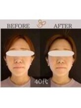 チョコバリ 錦糸町店(chocobari)/小顔×リフトアップ(美容鍼)40代