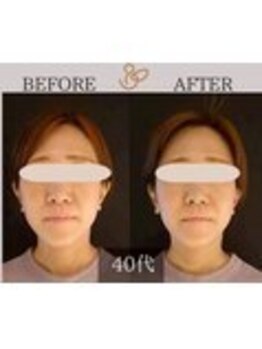 チョコバリ 錦糸町店(chocobari)/小顔×リフトアップ(美容鍼)40代