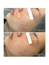 エヌプラス(N+)/20代女性＊ピーリング4回後(2)