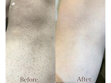 トリンテ バイ フェース(TRINTE by FAITH)/【ひざ下脱毛】14回(4週間隔)