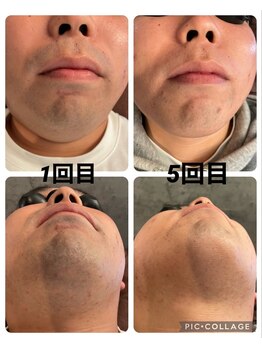 サクロス(Sacloth)/20代後半3回～5回で印象up