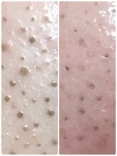 ビエル(Bielle)/頑固な黒毛穴のつまりもスッキリ