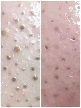 ビエル(Bielle)/頑固な黒毛穴のつまりもスッキリ