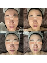 ダリア(Dahlia)/高周波ケア★サーマルリフト