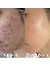 プラウディア(PROUDIA)&nbsp;ダイエット 痩身