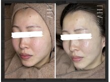 韓国女優の様なウルツヤ水光肌には角質除去【ララピール】