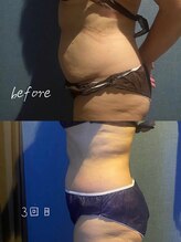 優来 神田店/ハイパーナイフ［神田/痩身］