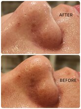 サロン ドゥ メビウス 春日店(salon de mebius)/毛穴引き締め/透明感/美白/艶肌