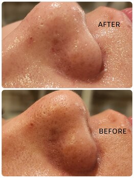 サロン ドゥ メビウス 春日店(salon de mebius)/毛穴引き締め/透明感/美白/艶肌