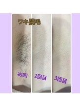 サンテ(Sante)/脇脱毛！ビフォーアフター☆