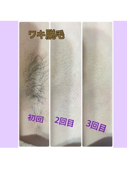 サンテ(Sante)/脇脱毛！ビフォーアフター☆