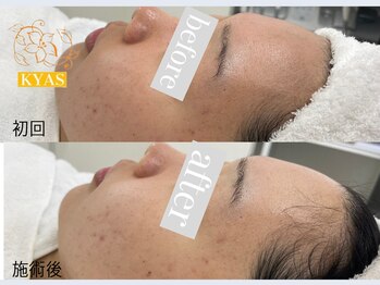 キャス(KYAS)/[ハーブピーリング]ニキビケア◎