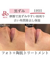 アイビー(IVY)/ハーブピーリング＋光フォト