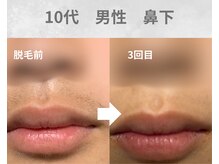 バーム(BAAM)/施術経過