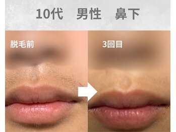 バーム(BAAM)/施術経過