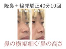 ラプリ 大阪心斎橋店(Raplit)/隆鼻＋輪郭矯正40分10回