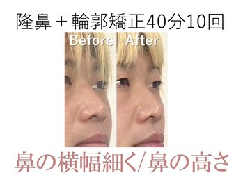 ラプリ 大阪心斎橋店(Raplit)/隆鼻＋輪郭矯正40分10回