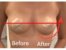 ベッピン(Beppin)/バストアップ症例写真