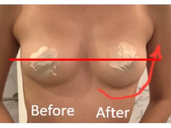 ベッピン(Beppin)/バストアップ症例写真