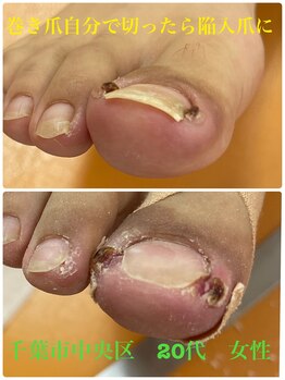 巻き爪じゅん 千葉駅前店/巻き爪が刺さって陥入爪に！