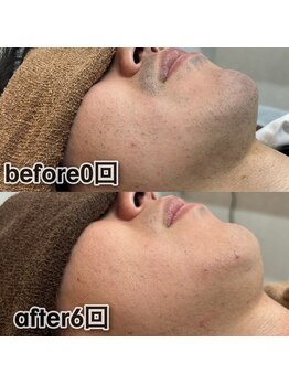 ボウイズ 磐田店(BOYZ)/ヒゲ脱毛　6回　before after