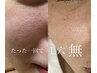 【リピート率95％以上★】初めての方にも◎美容大国韓国産ハーブピーリング