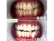 ルブラン 奈良店(Le Blanc)/艶も出る当店のホワイトニング！